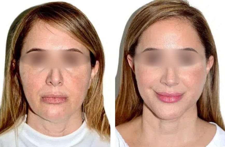 Lifting Facial y Cuello caso 9 — antes y después